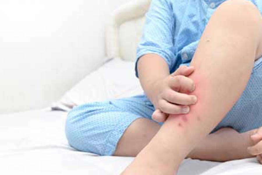 Child itching bed bug bites on exposed legs